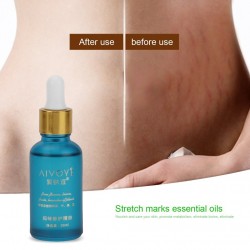 Stretch mark removal fast Pregnancy Postpartum Repairing Remove Stretch Marks 30ml